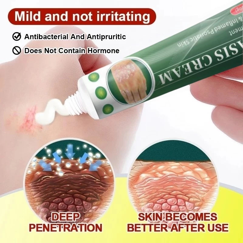 Salep Herbal Kulit 20g Krim Perawatan Kulit Gatal Kering Mengelupas Untuk Tangan Kaki Lipatan Kulit 