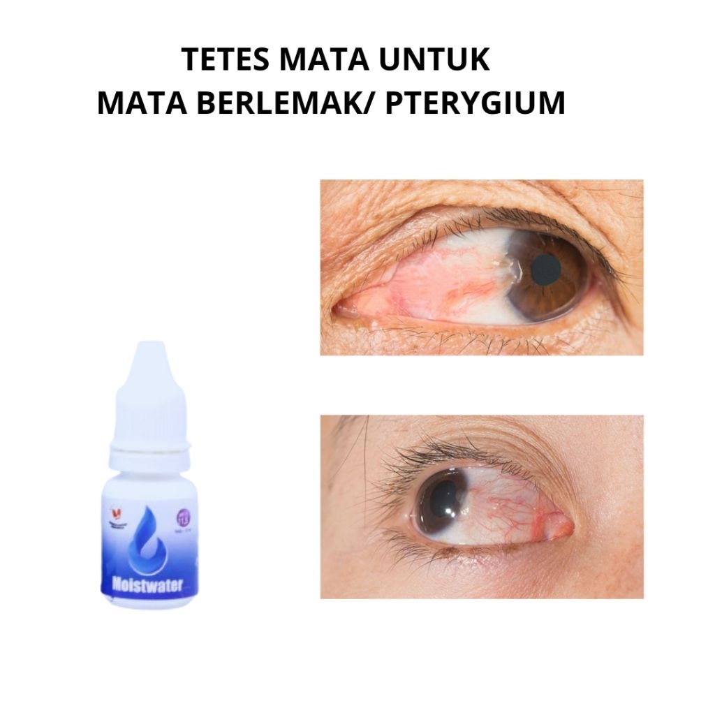 TETES MATA untuk mata berlemak/ pterygium -  pinguecula