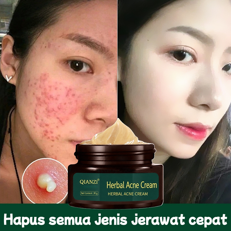 Ampuh Cream Penghilang Jerawat Herbal 30g Penghilang Bekas Jerawat Bopeng Obat Totol Jerawat Pria da