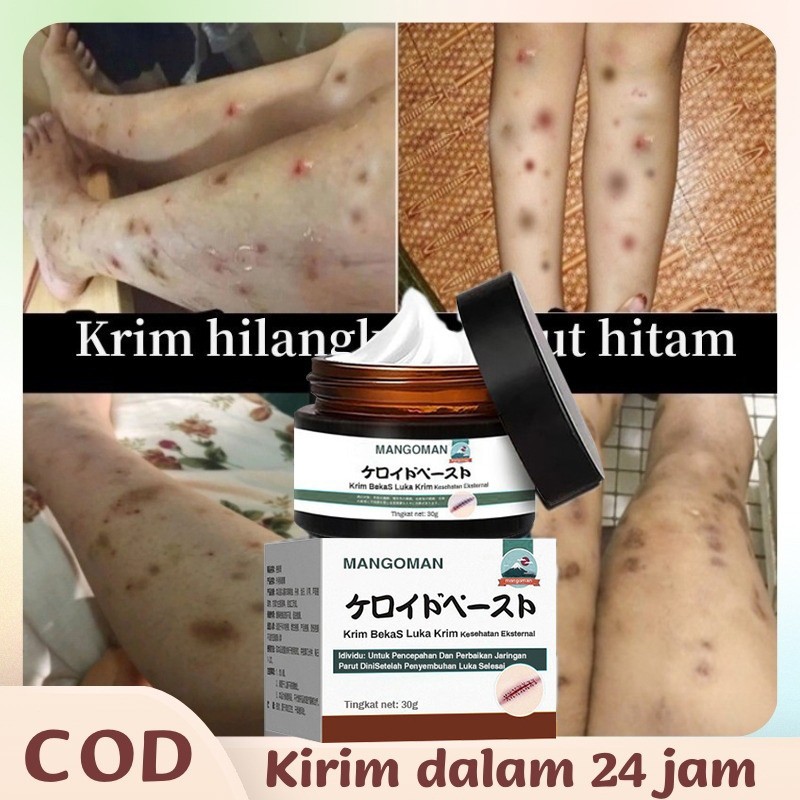 Krim Penghilang Bekas Luka Obat Penghilang Bekas Luka Bekas Luka Jahitan Gigitan Serangga Bekas Luka