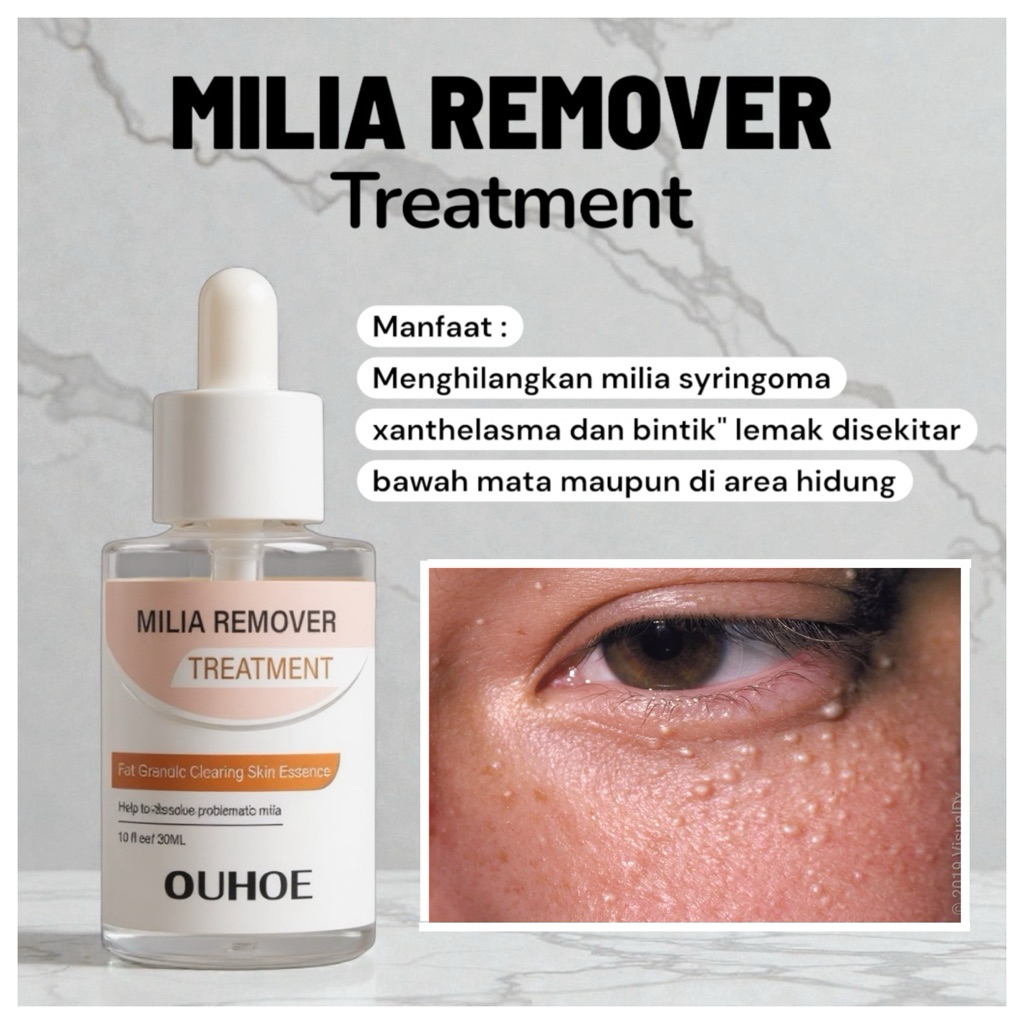 Milia remover serum penghilang perontok milia bintik putih mata Ouhoe Milia Remover Treatment Oil-Fr