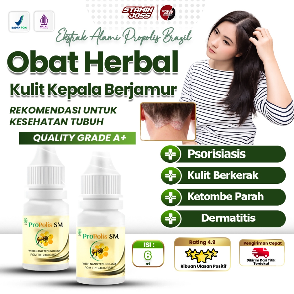 Salep Obat Jamur Kulit Kepala Gatal Psoriasis Kulit Kepala Berkerak Bersisik Budug Borok Dermatitis 
