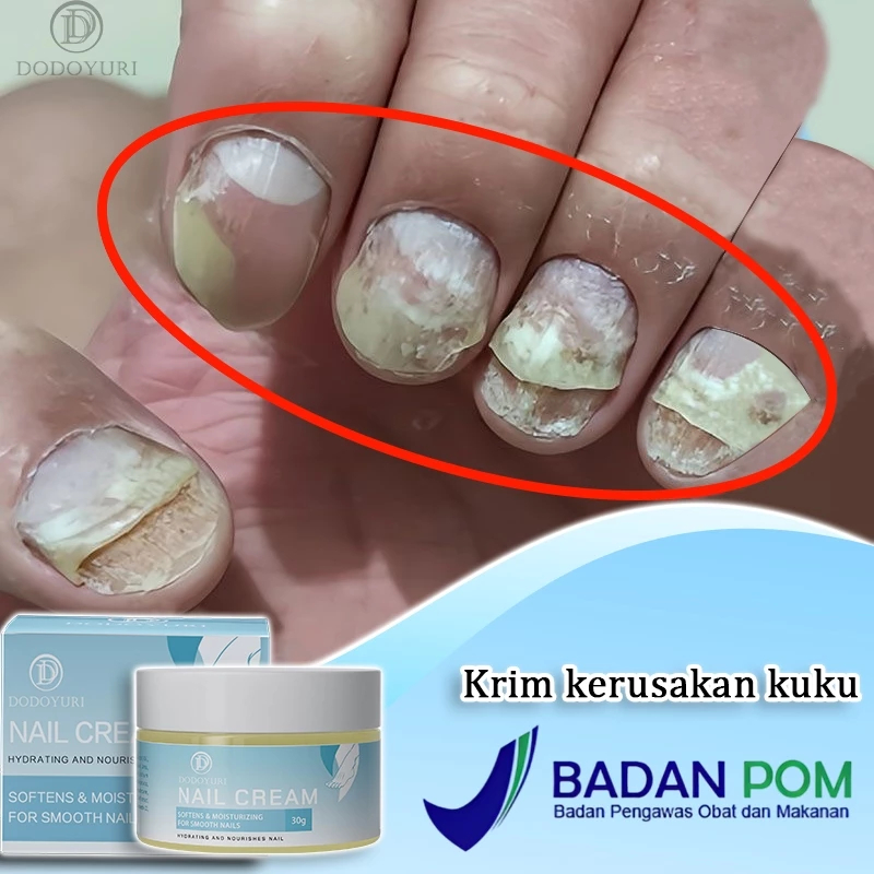 ORIGINAL- Serum kuku jamur dan rusak obat kuku jamur dan rusak obat jamur kuku 30g obat kuku rusak p