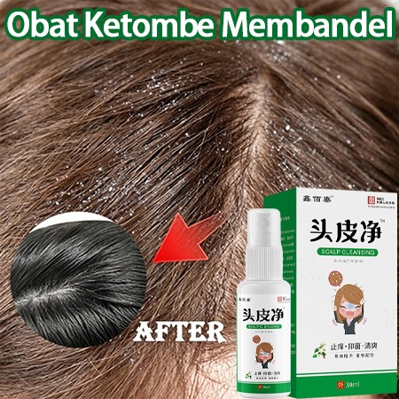 [COD]Obat Ketombe Paling Ampuh Kepala Gatal, Ketombe Berkerak Kepala Hilang Ketombe Kering dan Basah
