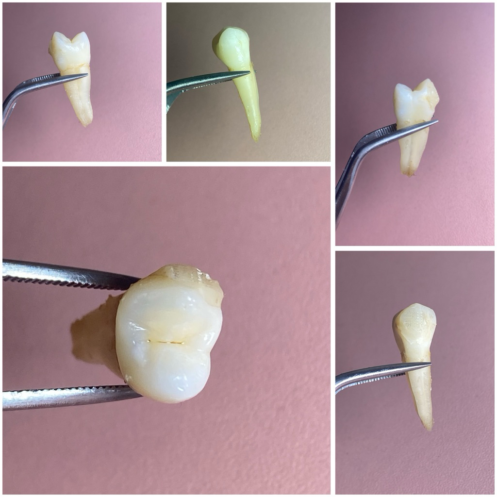 Gigi Asli Gigi Praktikum Premolar
