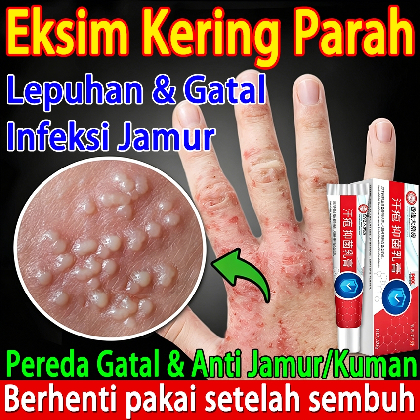 Salep gatal china paling ampuh salep gatal jamur selangkanga Krim Eksim Bayi dan Anak Obat gatal sel