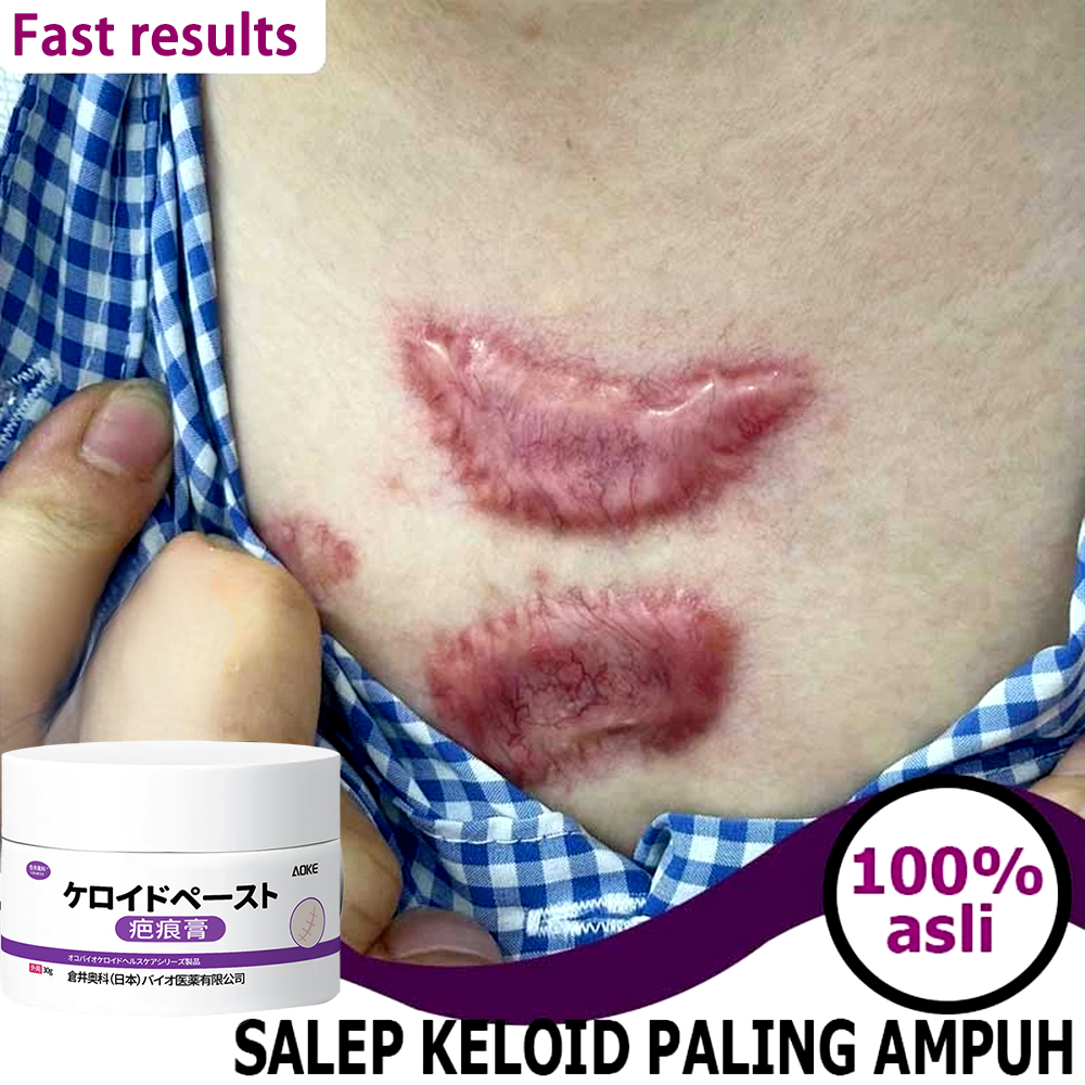 obat keloid Obat Penghilang Bekas Luka Lama penghilang bekas luka anak bekas luka koreng penghilang 