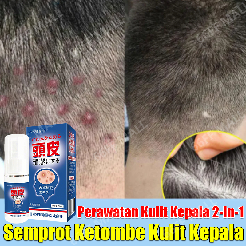 obat ketombe anti ketombe penghilang ketombe paling ampuh dermatitis seboroik obat jamur kepala psor