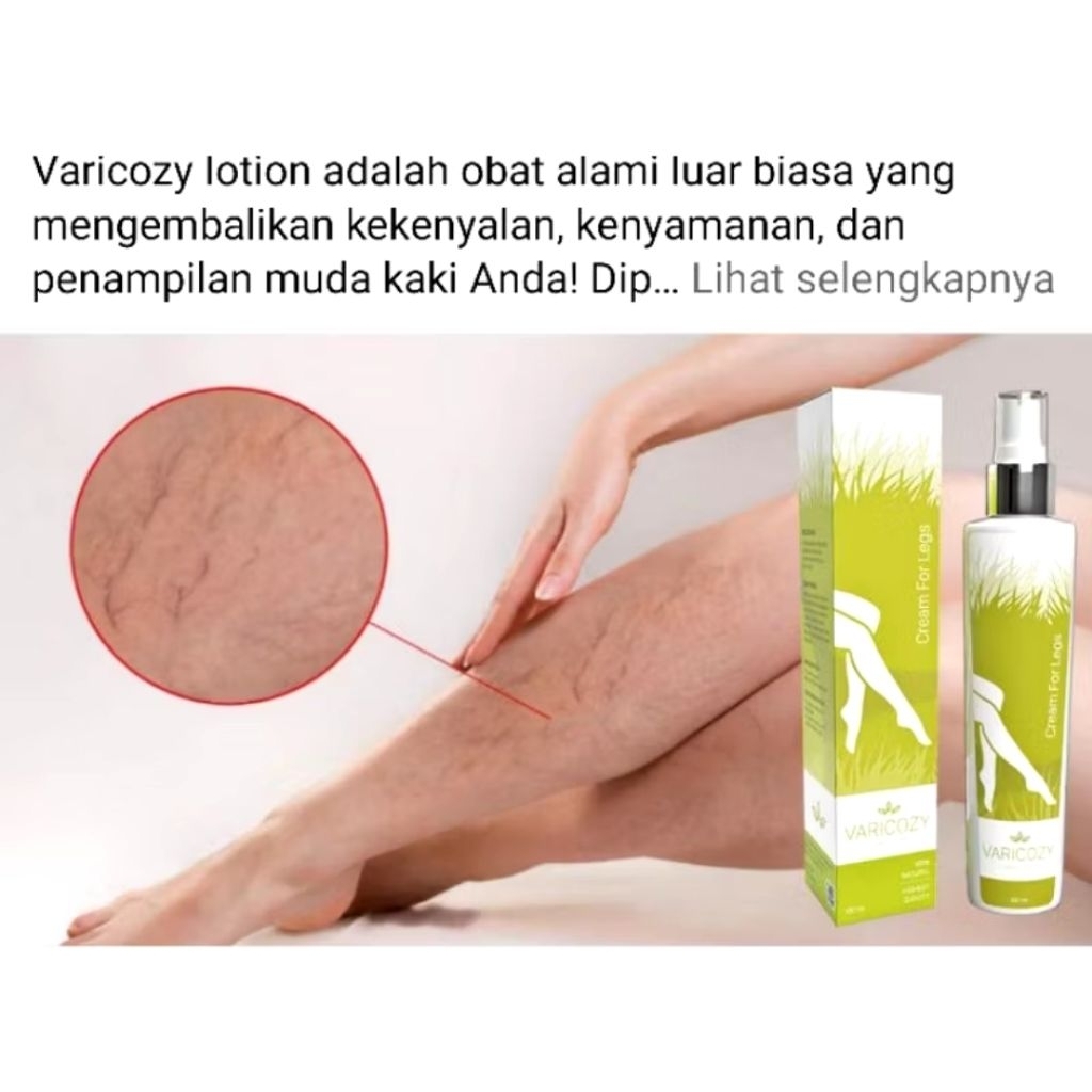 Varicozy Cream Atasi Varises Original Bpom