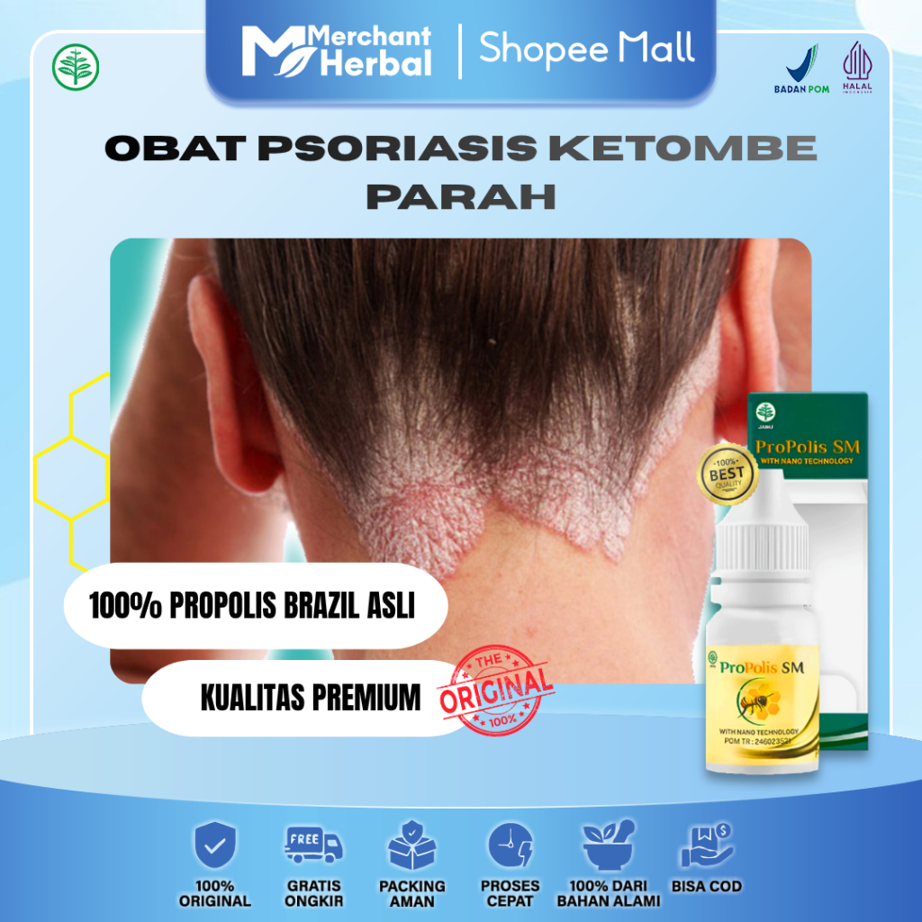 KETOMBE PARAH PSORIASIS KEPALA – Propolis SM