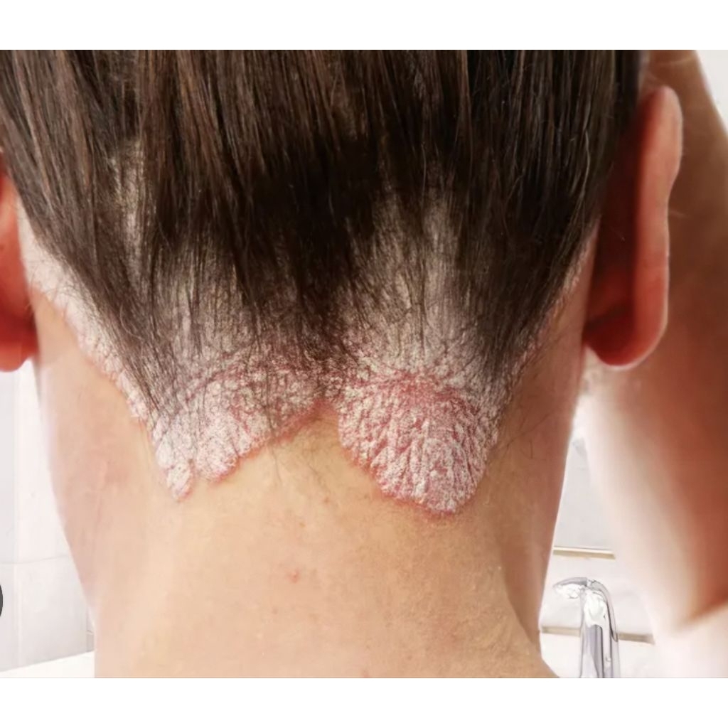 Krim Psoriasis