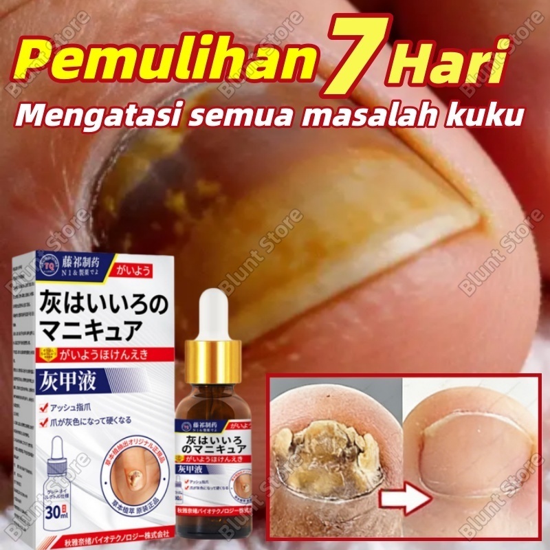 Serum Kuku Obat Kuku Jamur Dan Rusak Penghilang Jamur Kuku Obat Jamur Kuku  Obat Perawatan Kuku Jamu