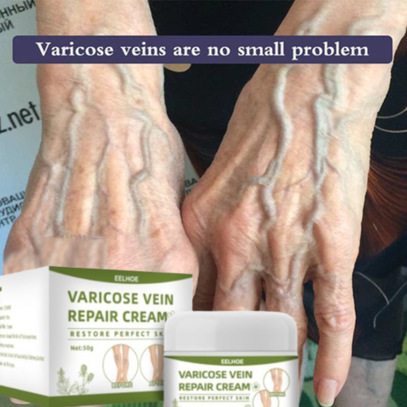 Varicose Veins Cream Salep Varises Ampuh Obat Varises Paling Ampuh Obat Varises Di Kaki 50g