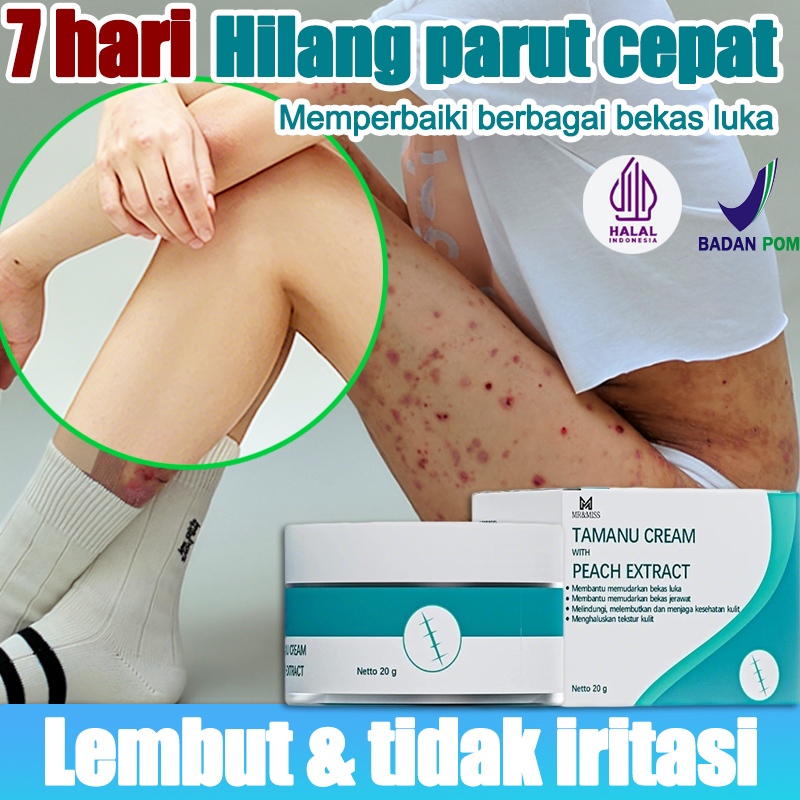 Cream penghilang bekas luka 20g Penghilang Bekas Luka untuk Anak-anak Ampuh salep luka bakarPenghila