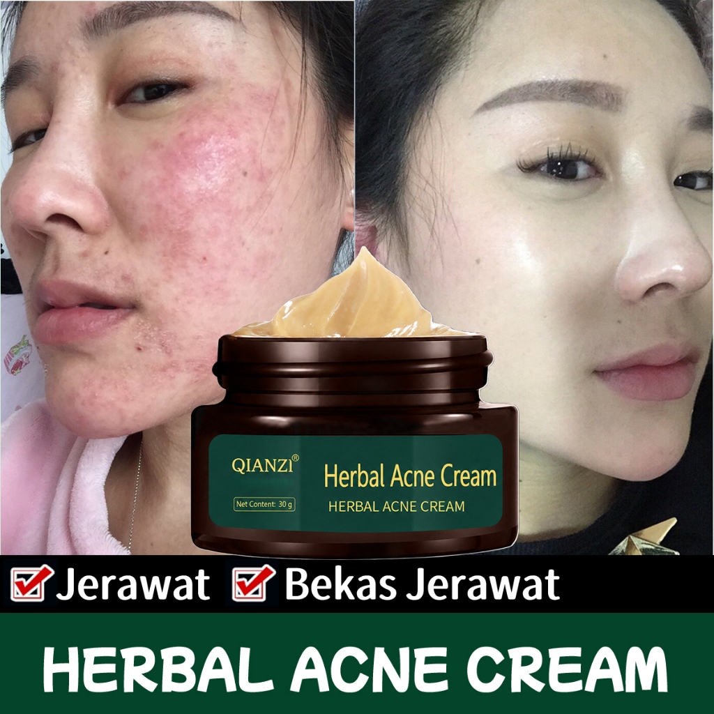 Ampuh Cream Penghilang Jerawat Herbal 30gr Penghilang Bekas Jerawat Bopeng Obat Totol Jerawat Pria d