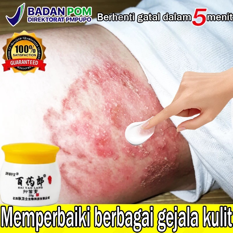 Salep gatal china paling ampuh salep gatal jamur selangkanga Krim Eksim Bayi dan Anak Obat gatal sel