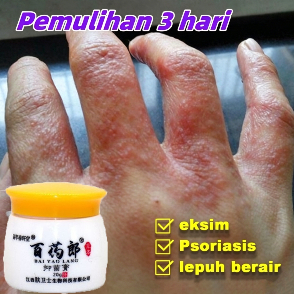Salep Eksim Kering dan Gatal Salep Gatal China Paling Ampuh Obat Gatal Selangkangan Salep Bayi Untuk