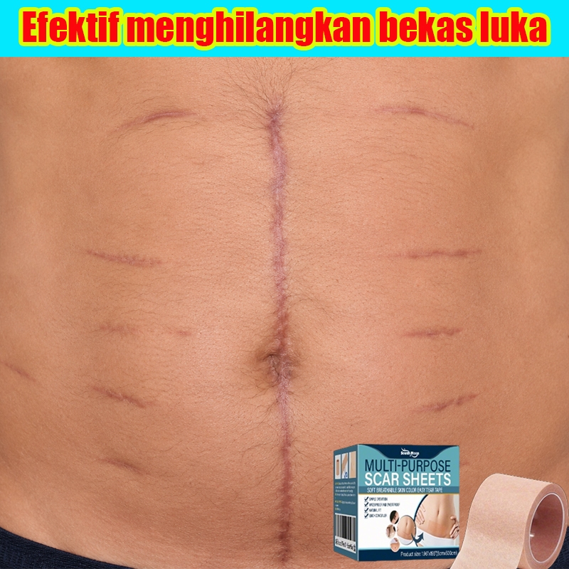 Silicone Scar Sheet penghilang keloid menghilangkan bekas luka keloid plester penghilang bekas luka 