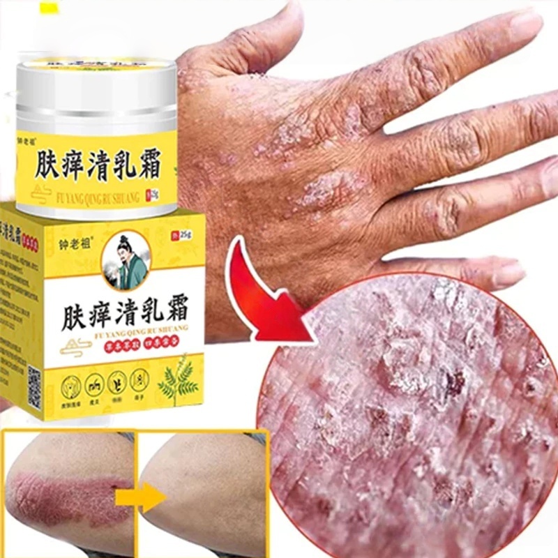 salep gatal paling ampuh Salep Eksim Kering dan Gatal Salep Bayi Untuk Kulit Iritasi obat eksim psor