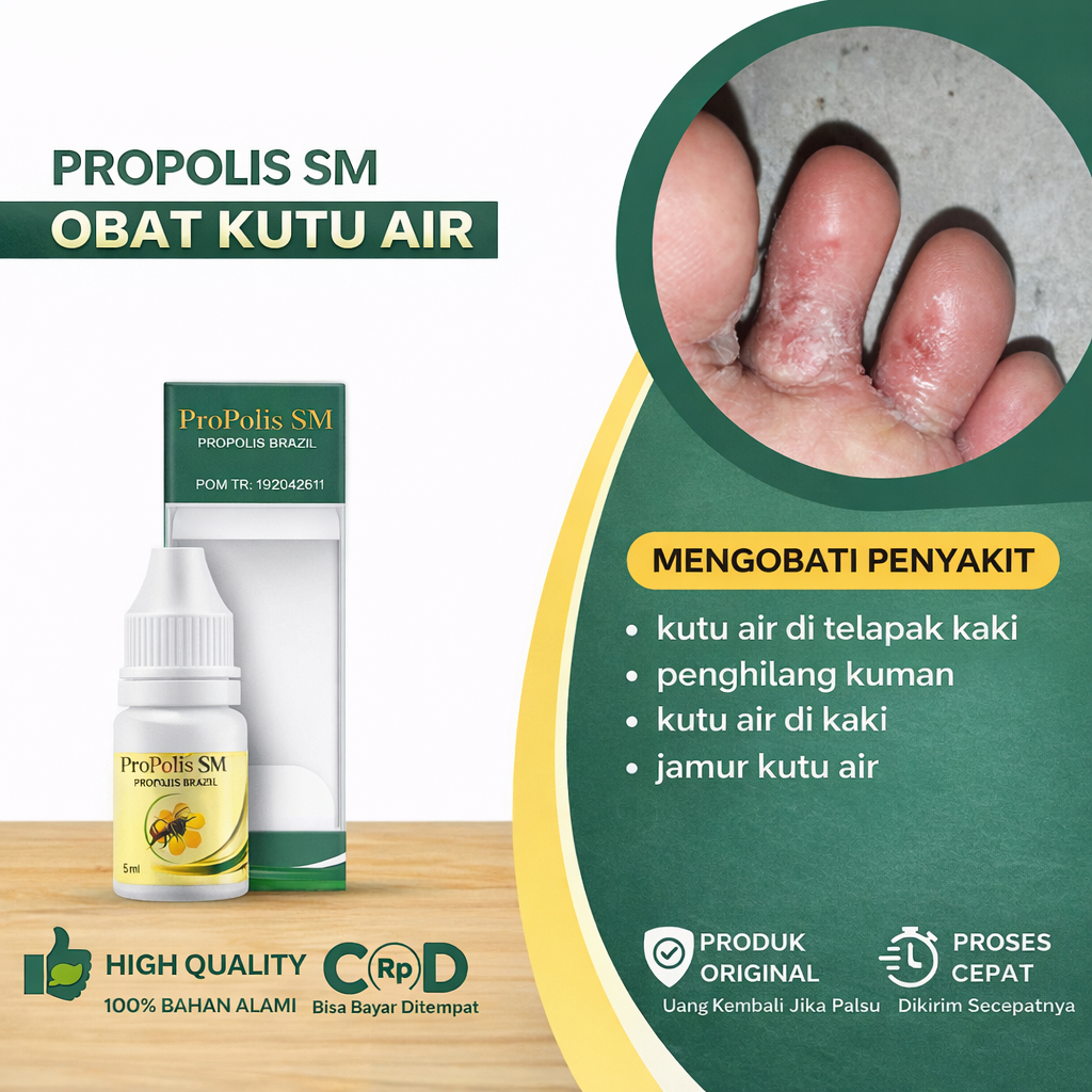Propolis SM untuk Kutu Air – Obat Jamur Kaki Gatal & Mengelupas