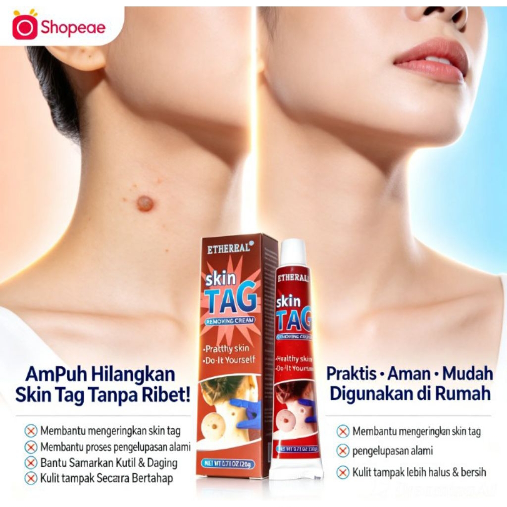 Skin Tag Removing Cream 20g Original Ampuh Krim Penghilang Skin Tag Salep Tag Kulit Praktis Efektif