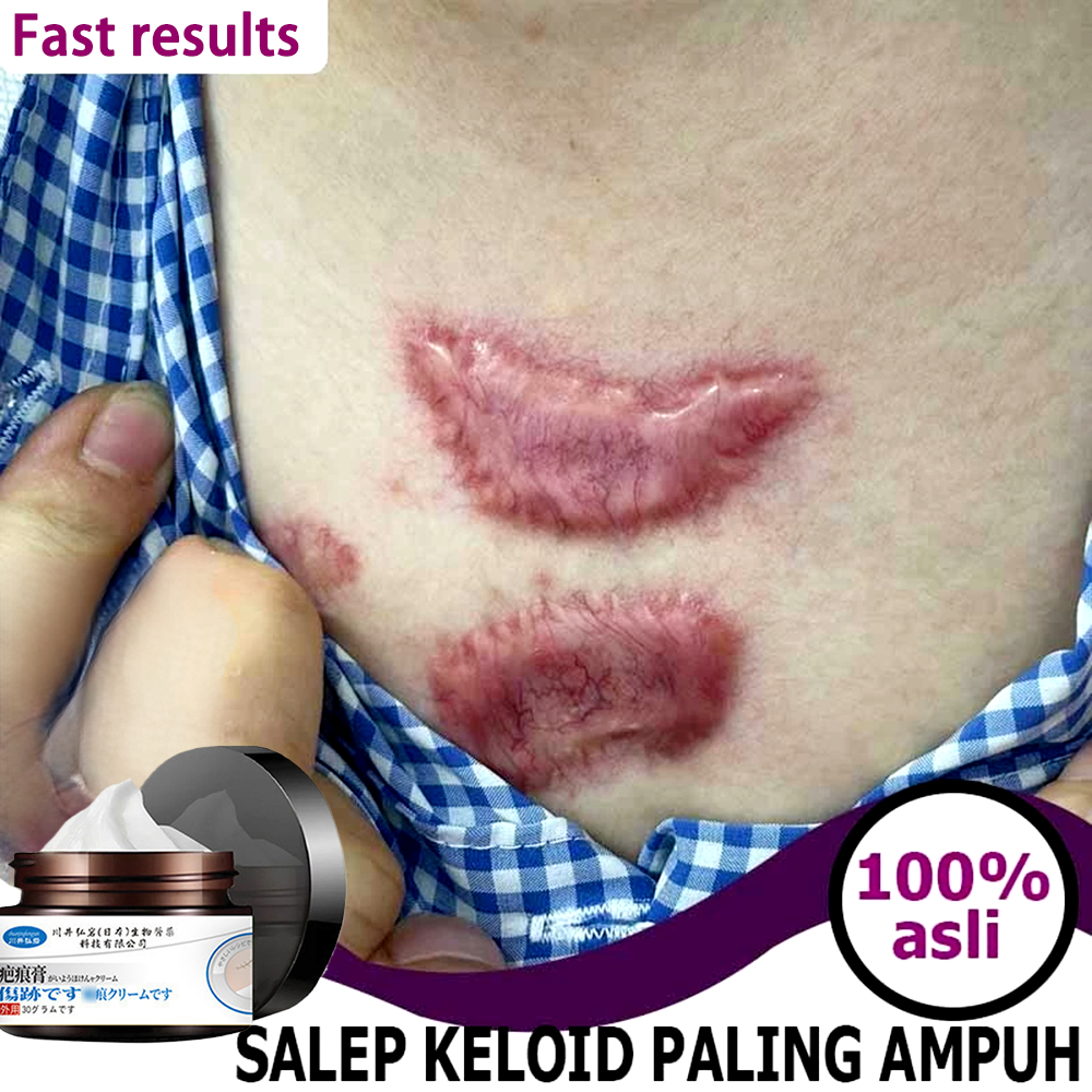 obat keloid Obat Penghilang Bekas Luka Lama penghilang bekas luka anak bekas luka koreng penghilang 