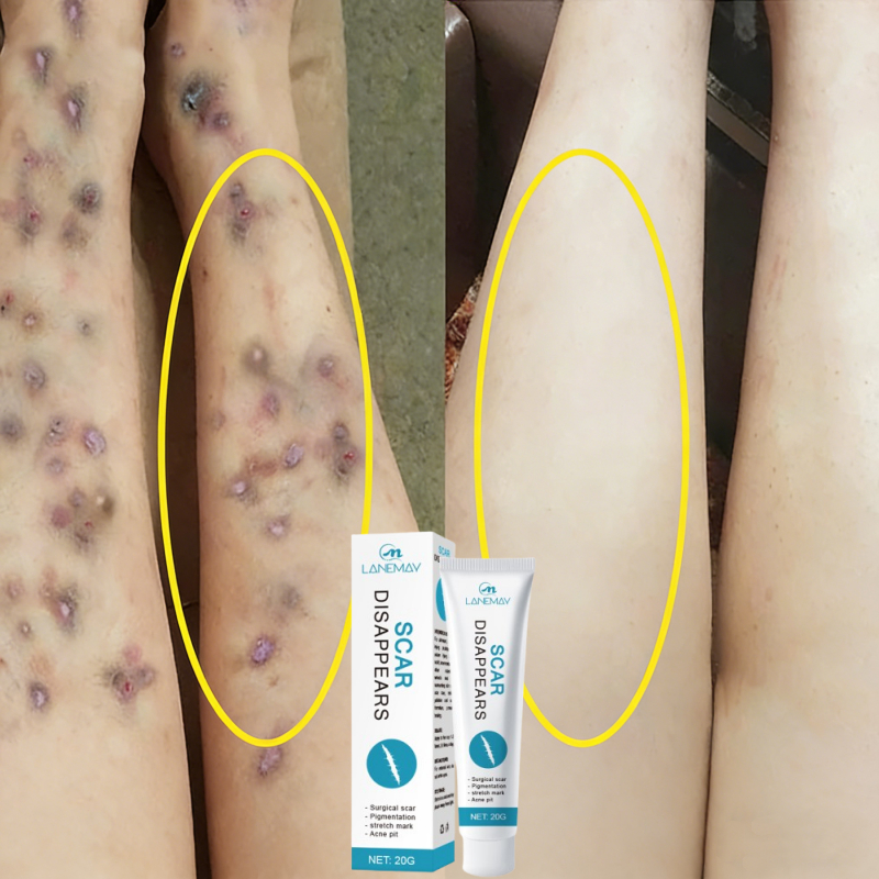 Bekas luka hitam di kaki Cream penghilang bekas luka koreng Salep bekas luka anak Pembersih bekas lu