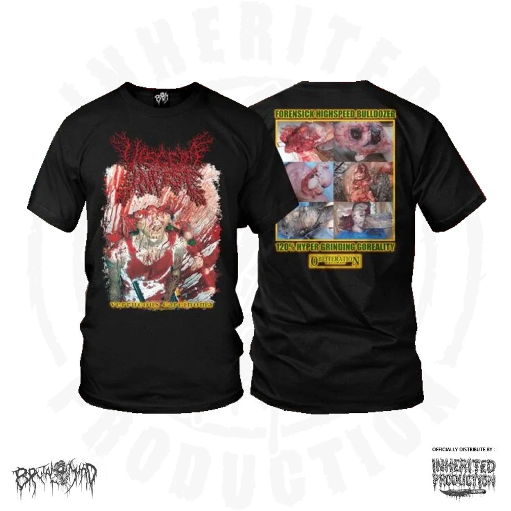 TS – VISCERA INFEST – Verrucous Carcinoma