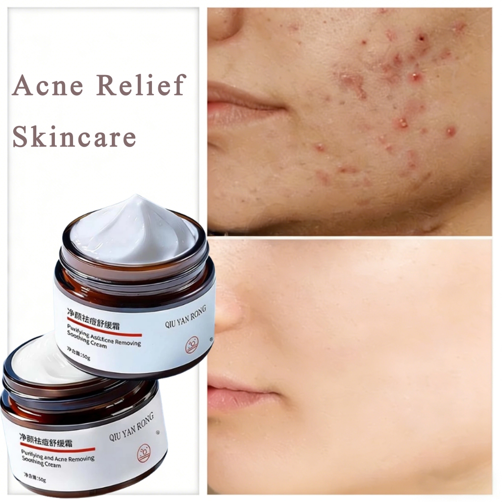 Obat Menghilangkan Jerawat Membandel Acne Spot Treatment Cream Acne Cream Salep Jerawat Pria Wanita 