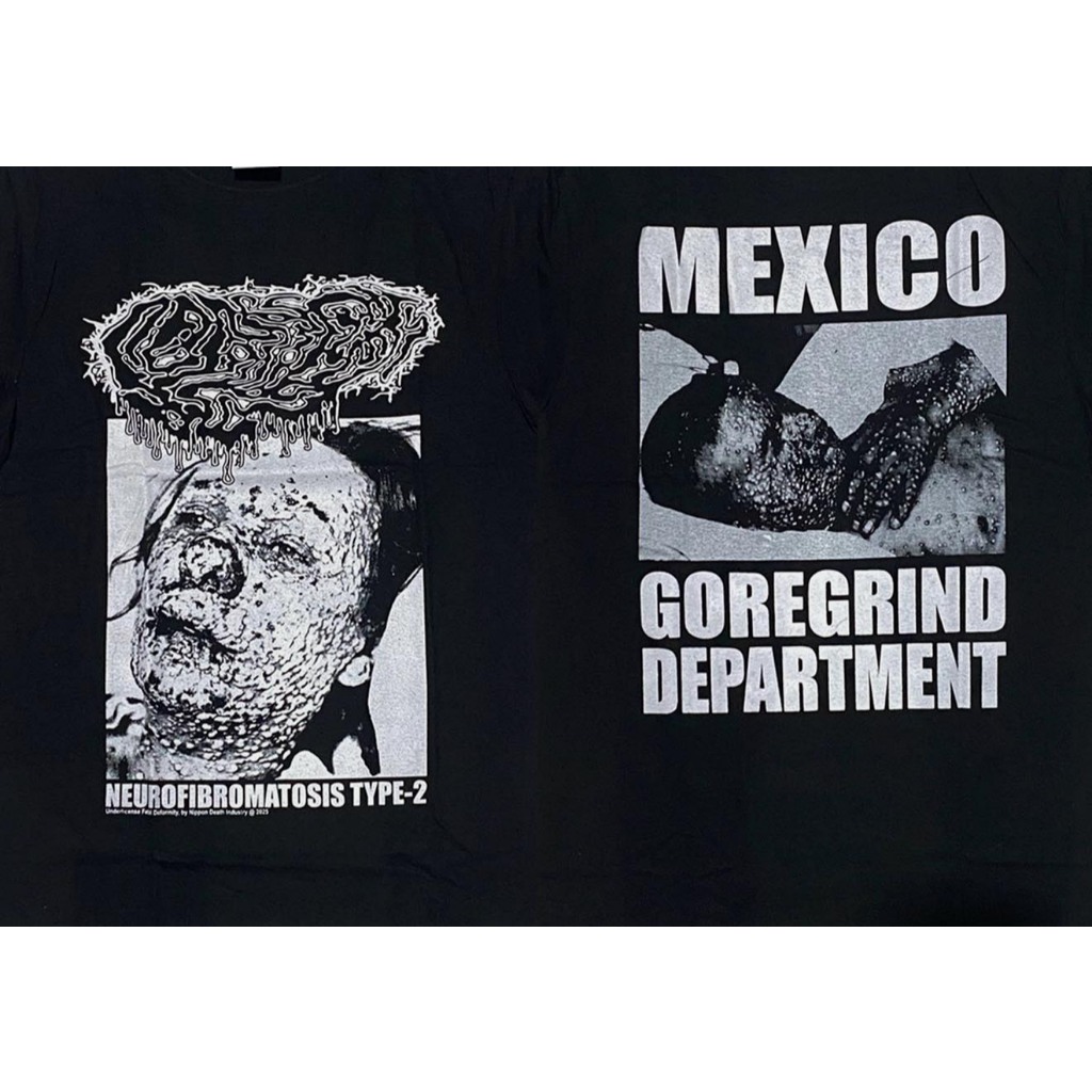 TS – FETAL DEFORMITY – NEUROFIBROMATOSIS TYPE-2