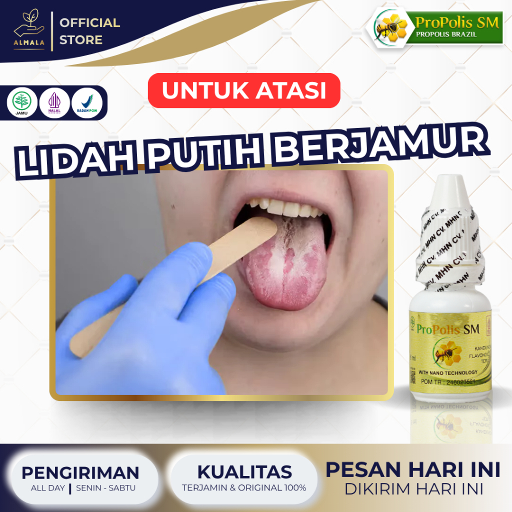 Obat Lidah Putih Berjamur, Obat Penghilang Bintik Putih Di Lidah, Obat Pembersih Lidah Berjamur, Oba