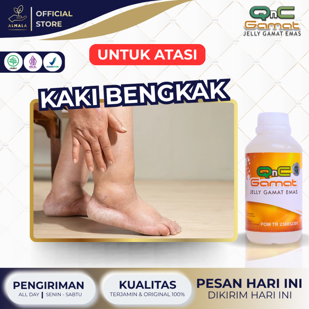 Obat Kaki Bengkak, Kaki Bengkak dan Nyeri, Kaki Bengkak Ibu Hamil, Kaki Bengkak Karena Jatuh, Sakit 