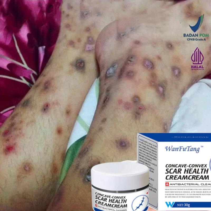 Agen penghilang bekas luka, agen penghilang bekas luka koreng hitam di kaki, agen penghilang bekas l