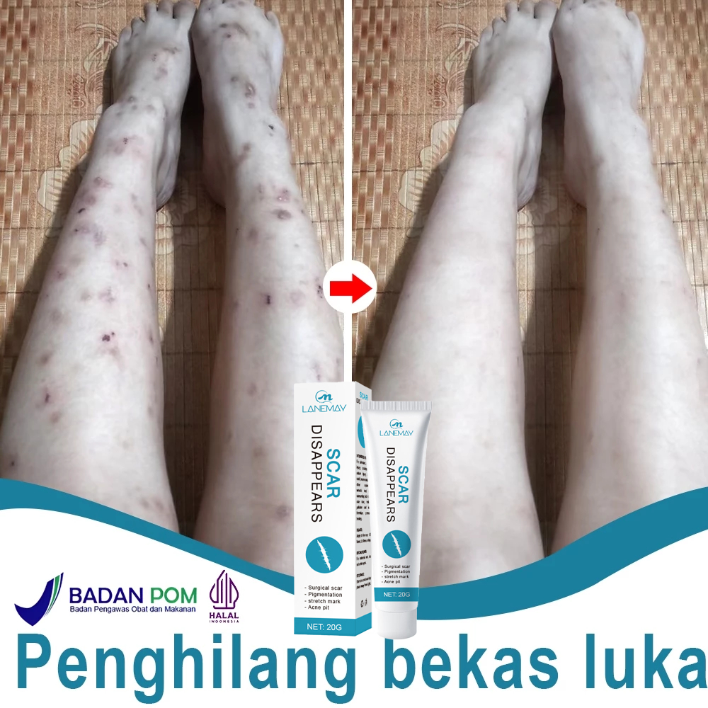 Krim Penghilang Bekas Luka, Salep Penghilang Bekas Luka, Menghilangkan Keropeng, Keloid, Bekas Luka 