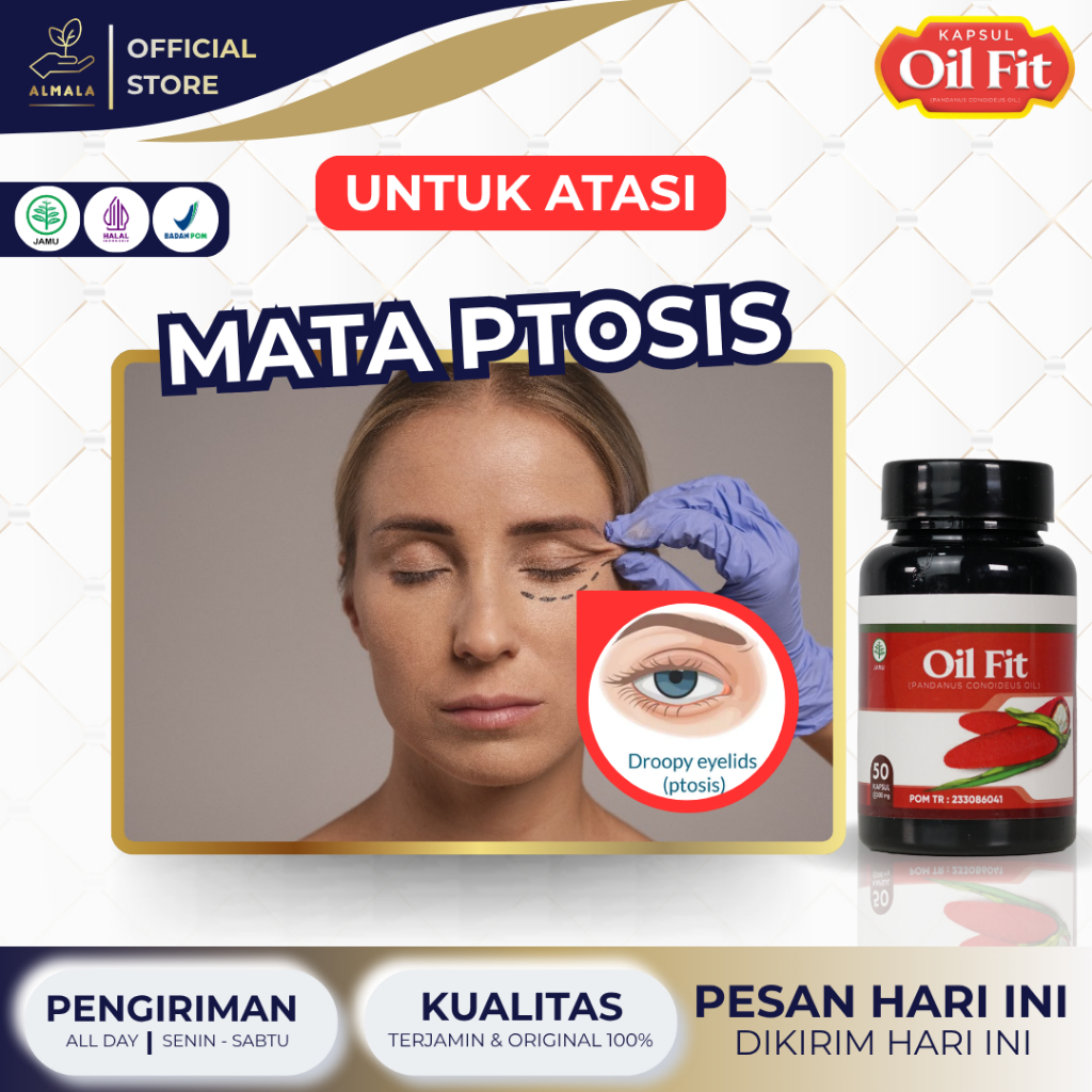 Obat Mata Ptosis Lipatan Kelopak Mata beda sebelah mata sipit sebelah Gangguan Pada Kelopak Mata Kel