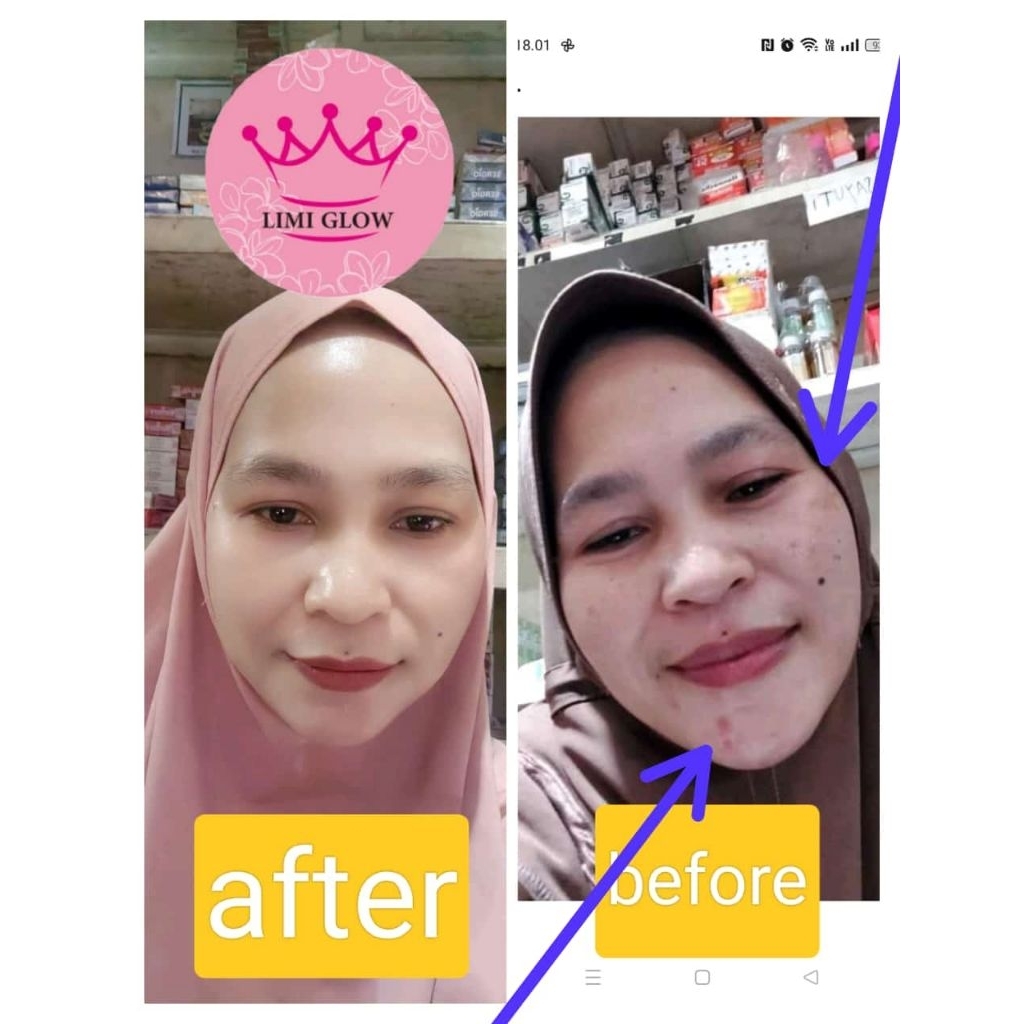 Salep flek LIMI GLOW
