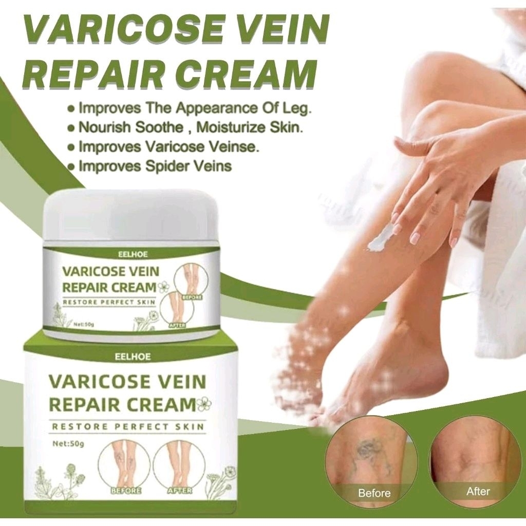 Varicose Veins Cream  Varises Salep Penghilang Varises Vaskulitis / Parises
