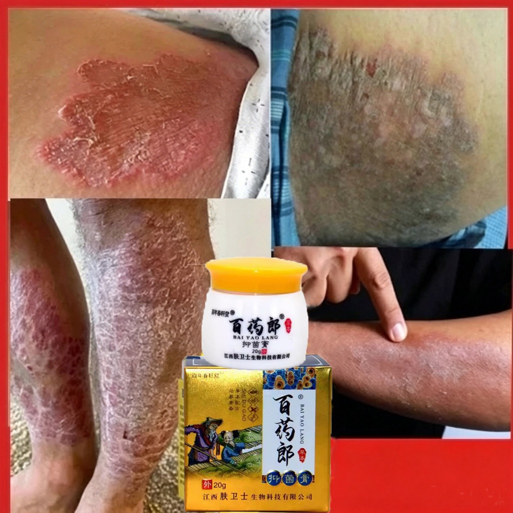 Salep gatal salep eksim kering dan gatal salep china gatal paling ampuh eksim kering salep gatal sel