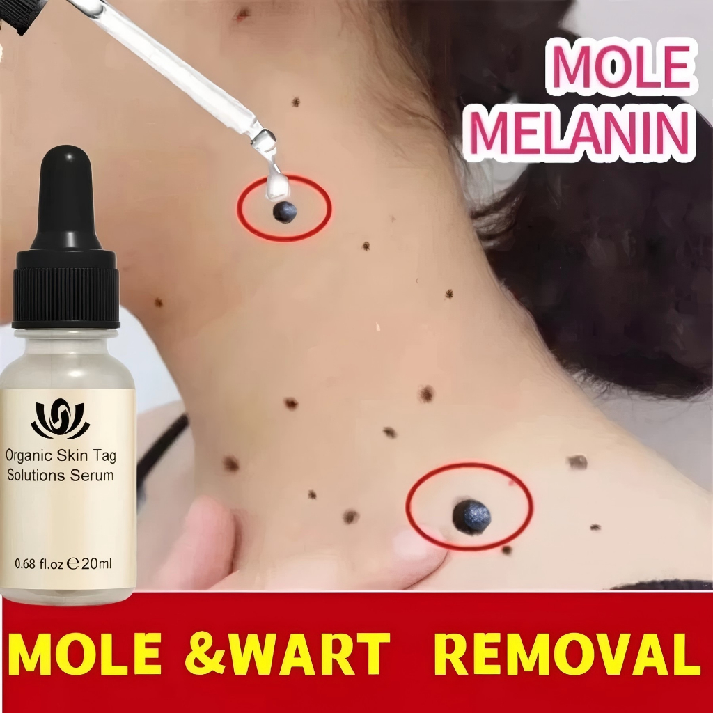 Minyak Esensial Penghilang Tahi Lalat Herbal- Penghilang Tahi Lalat Hidup Dan Mati Di Wajah Tanpa La