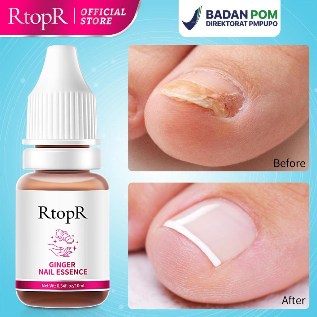 BPOM RtopR Jahe Antibakteri Perawatan Kuku Onikomikosis Paronychia Anti Infeksi Kuku Toe Nail Pengob
