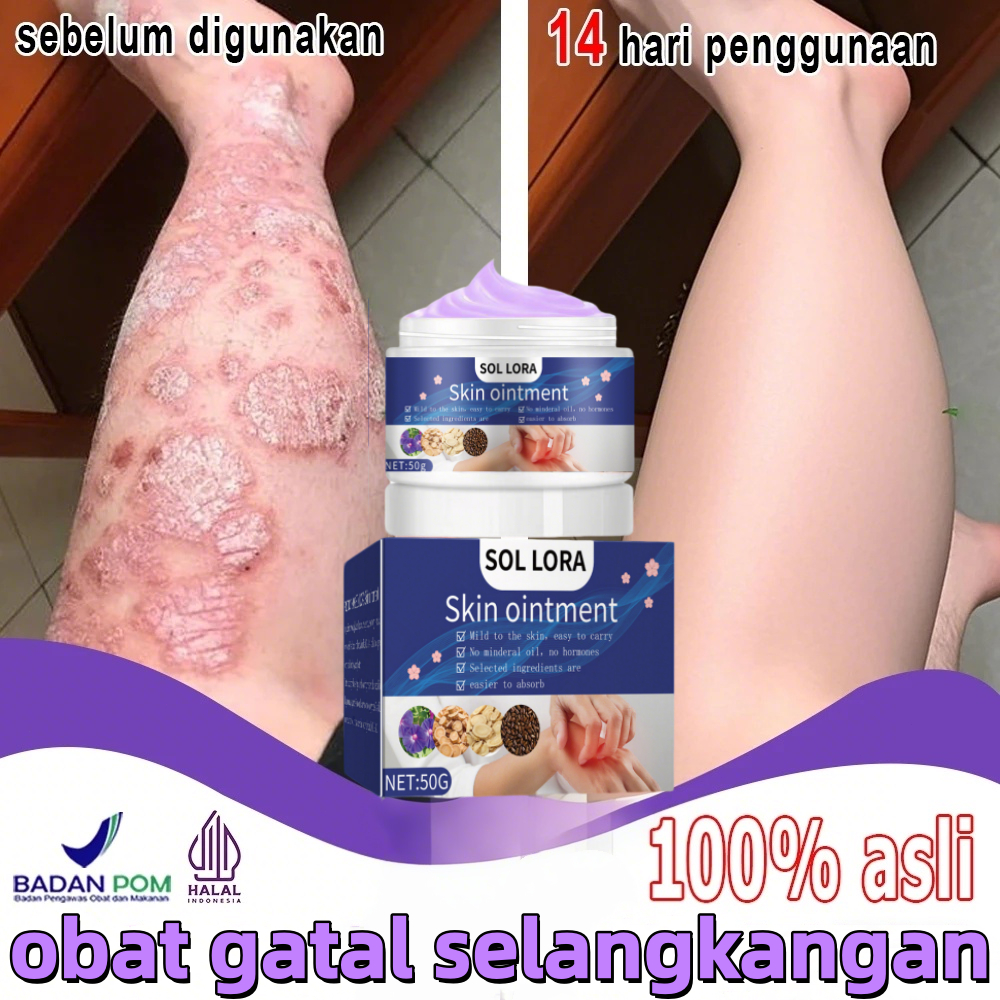 Salap gatal kulit yang ampuh Obat gatal selangkangan Salep gatal paling ampuh 50g Salep gatal miss v