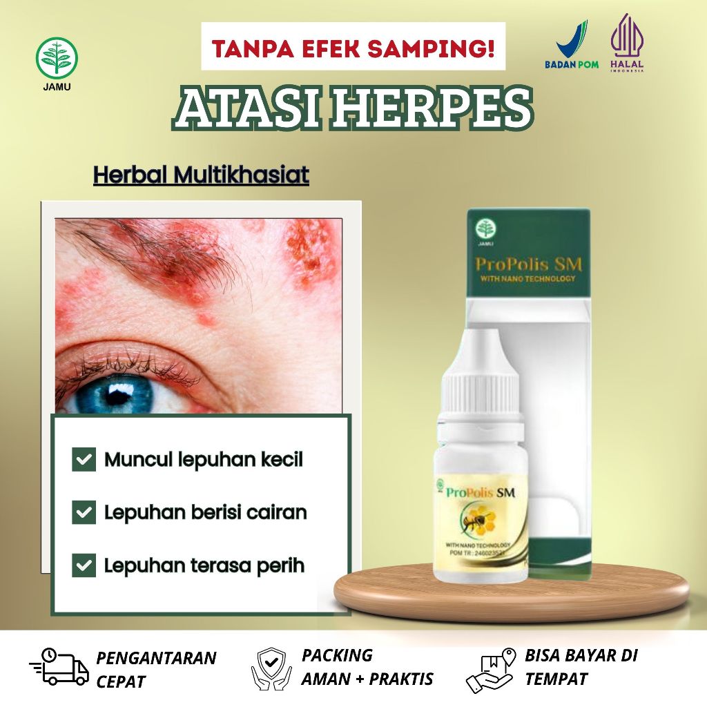 Obat Atasi Herpes, Muncul Lepuhan Kecil, lepuhan Terasa Panas, Luka Herpes, Luka Herpes Terbuka, Her