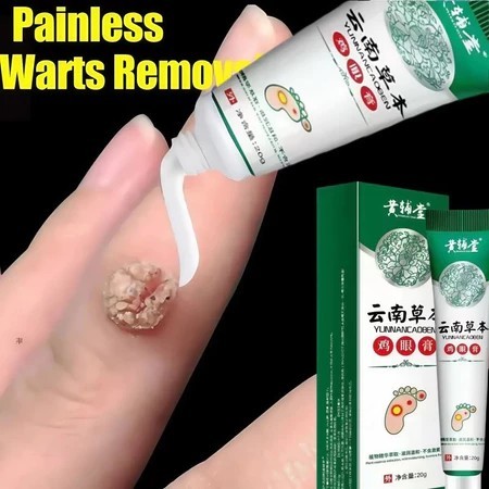 Obat Mata Ikan Pada Telapak Kaki, Perontok Mata Ikan di Telapak Kaki & Tangan