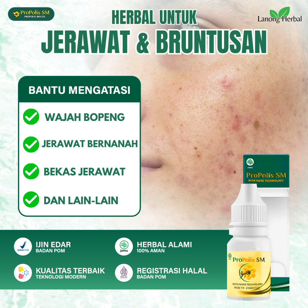 Obat Jerawat Batu & Beruntusan Propolis SM - Penghilang Bekas Jerawat & Bopeng - Solusi Jerawat Besa