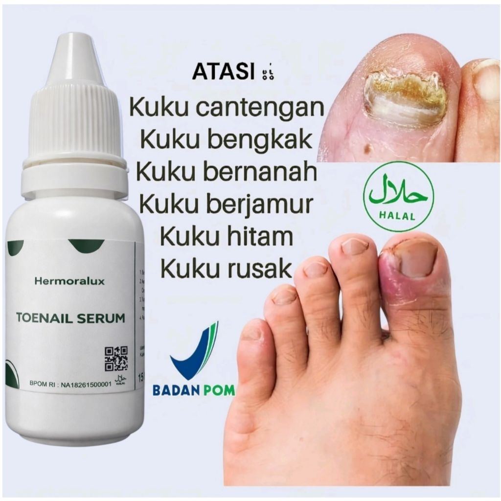 Bpom Diacoil Nail Serum Obat Kuku Jempol Kaki Cantengan Bengkak Bernanah Jamur Rusak Menghitam