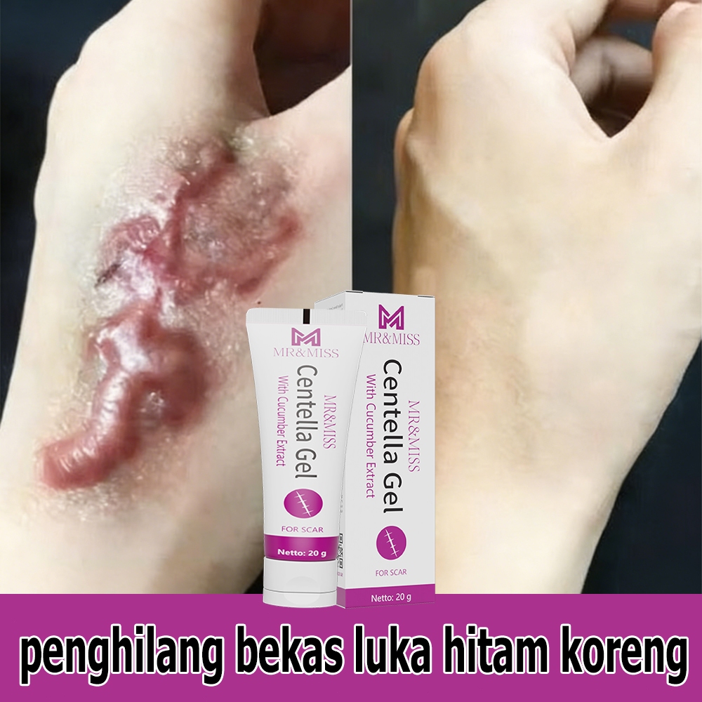 Salep penghilang bekas luka Obat penghilang bekas luka Penghilang bekas luka hitam koreng Menghilang