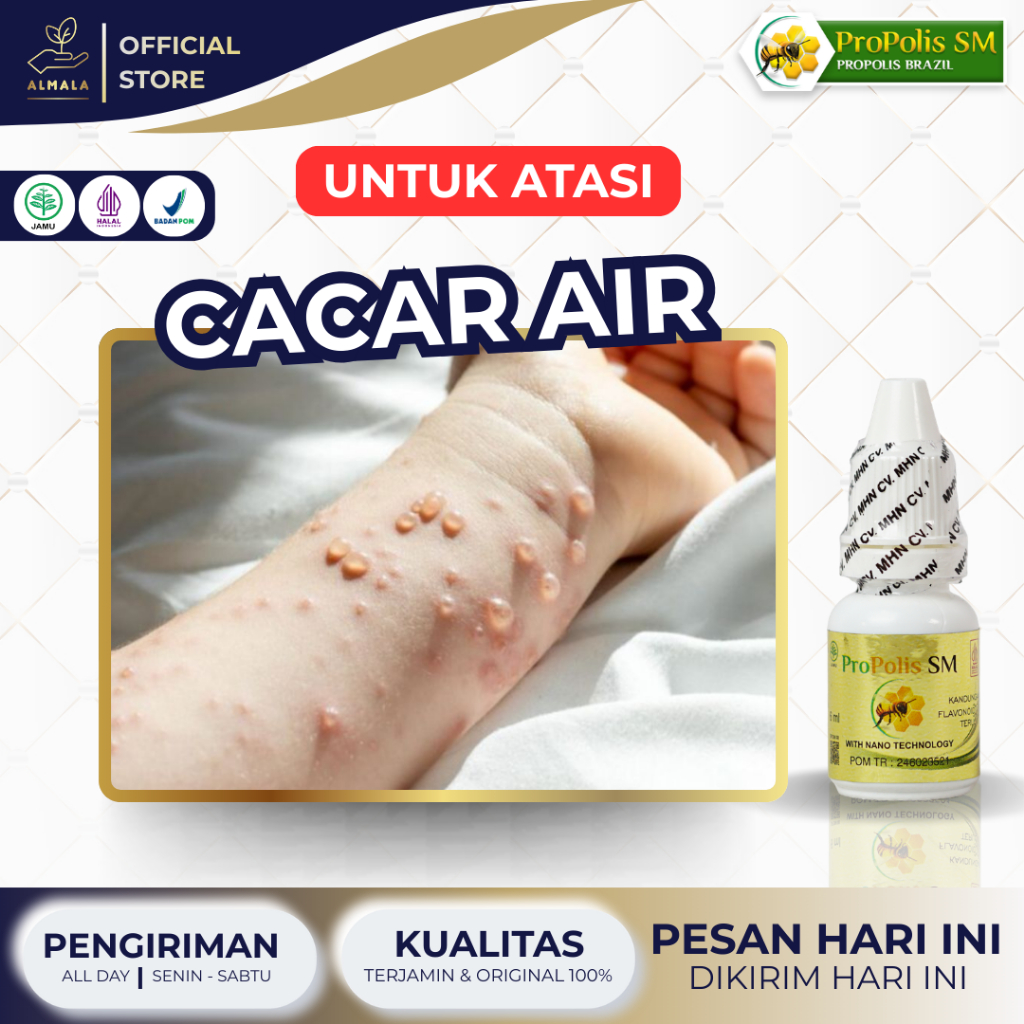 Obat Cacar Air, Obat Cacar Api, Obat Penghilang Bekas Cacar, Obat Herpes Kulit, Obat Cacar Monyet, O