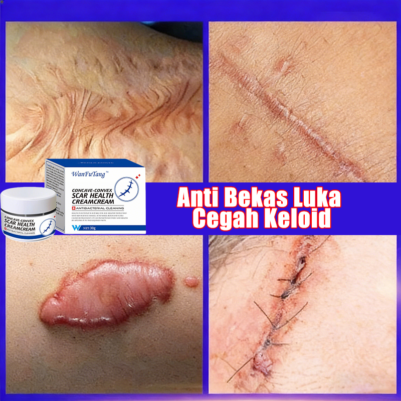 cream penghilang bekas luka koreng penghilang bekas luka hitam koreng penghilang bekas luka penghila