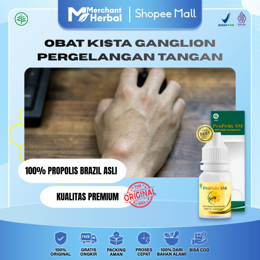 Kista Ganglion Pergelangan Tangan, Nyeri & Kebas – Propolis SM