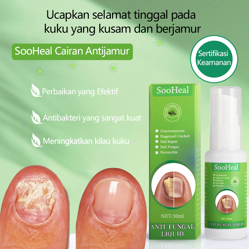 Obat kuku,obat kuku cantengan,30ml,Obat jamur kuku kaki,serum kuku jamur dan rusak,obat kuku rusak,s